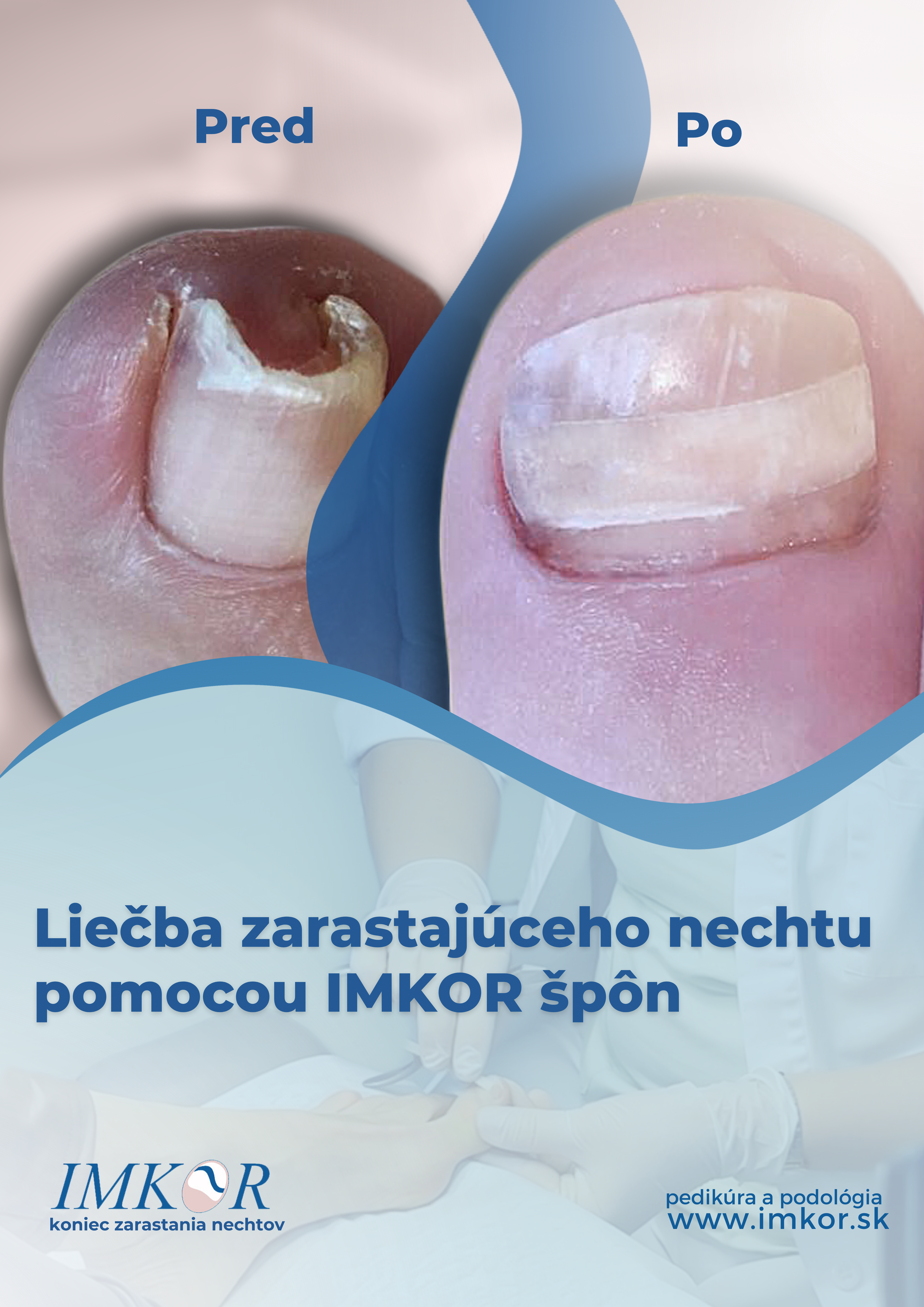 IMKOR pásik 1 ks dlhý 6,5cm + Lepidlo 7,5g(vyrobíte cca 3 IMKOR špony)